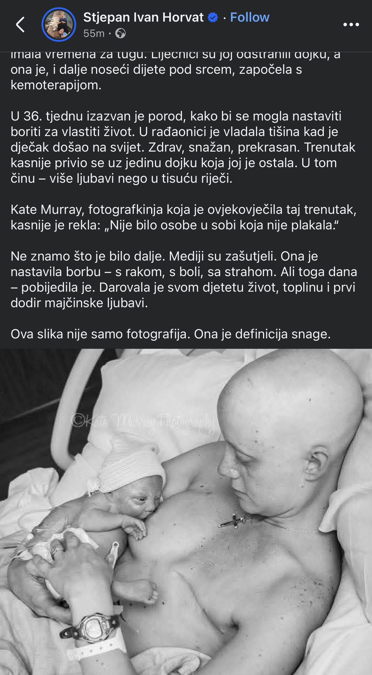 MAJKA, BEZ KOSE, AMPUTIRANA JEDNA DOJKA: Sa životom u stomaku i SNAGOM KOJA MENJA SVET- Fotografija zbog koje je SVET PLAKAO