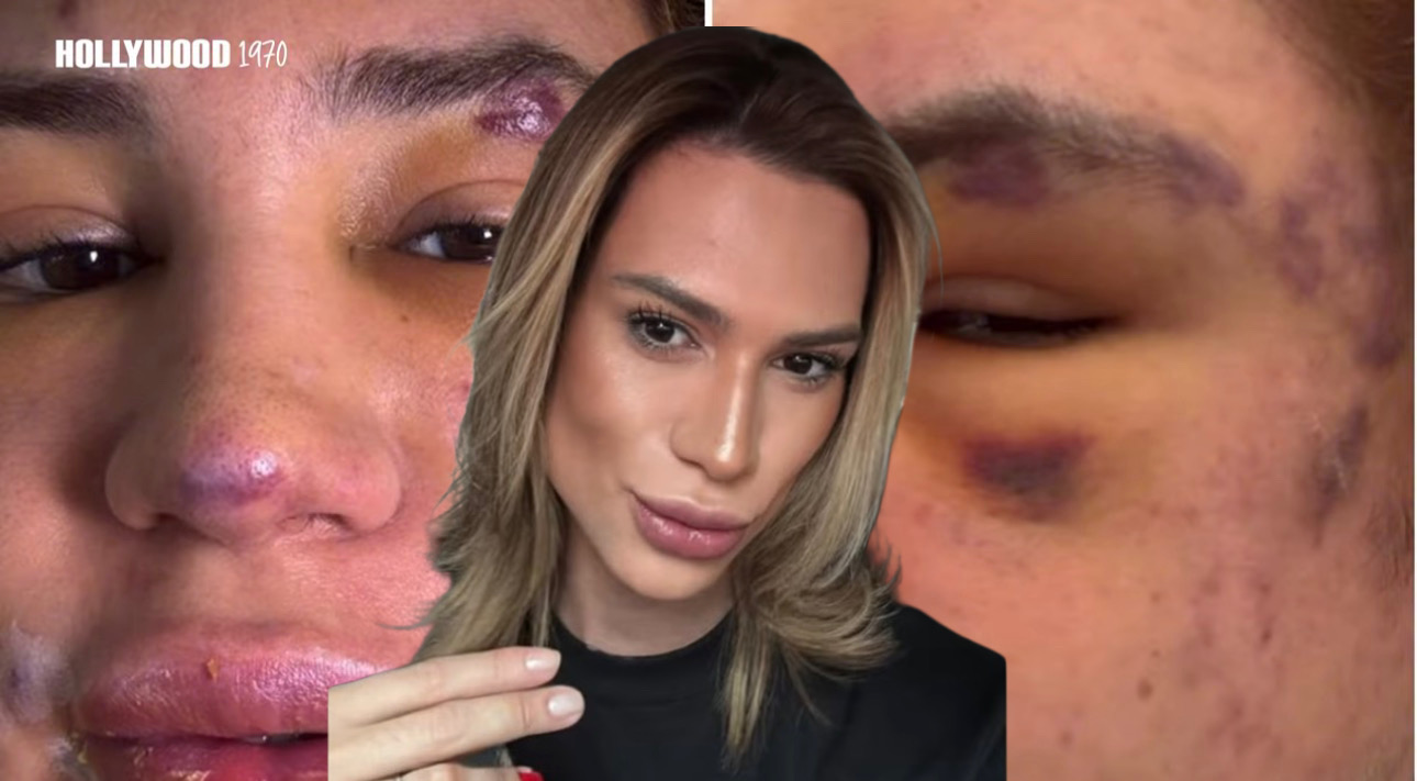 “FOX EYES” ZAHVAT POŠAO PO ZLU: Influenser osetio da nešto nije u redu, a onda je POČEO DA SE GUŠI, proglašen je MRTVIM