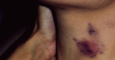 Momak (17) iz Meksika preminuo nakon što mu je devojka napravila „šljivu“ na vratu